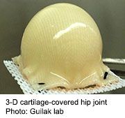 Progress has been made toward developing lab-grown cartilage that could postpone or possibly eliminate the need for hip replacement surgery in younger arthritis patients
