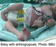 The Zika virus may be the cause of joint deformities in the arms and legs of newborns (arthrogryposis)