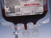 Using the freshest blood for transfusions does not appear to significantly improve patient survival