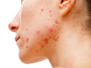 Factors that are associated with the appearance of acne in adult women include family history