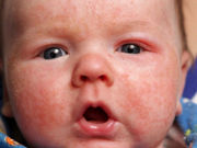 High transepidermal water loss in infancy is associated with atopic eczema at age 2 years
