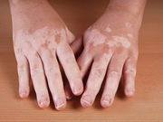 The clinical features of vitiligo are associated with age of disease onset