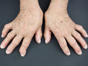 For patients with rheumatoid arthritis who have had an inadequate response to methotrexate