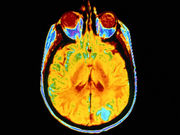 There's no link between cytomegalovirus and glioblastoma or other high-grade gliomas