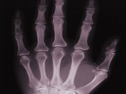 One in four adults in America report an arthritis diagnosis