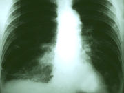 For patients with locally-advanced non-small-cell lung cancer
