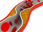 Sildenafil-coated stents appear to cut a patient's odds for clots