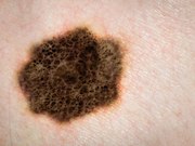 For patients with melanoma