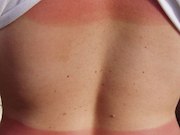 The prevalence of sunburn was 34.2 percent in 2015