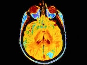 Positron emission tomographic imaging can directly measure synaptic loss with Alzheimer's disease