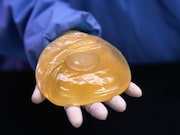 The long-term outcomes of breast implants include increased rates of certain conditions for silicone implants