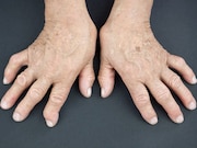 Once low rheumatoid arthritis disease activity is achieved with tocilizumab plus methotrexate
