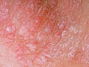 Psoriasis appears to be significantly associated with inflammatory bowel disease