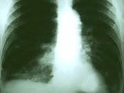 For patients undergoing resection for non-small cell lung cancer