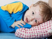 North Carolina's largest chickenpox outbreak in decades is centered in a primary school with a large number of vaccine-exempt students