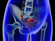 For patients with early-stage cervical cancer