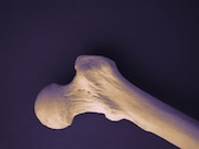 The risk for bone loss rises sharply in young breast cancer patients who received standard treatment