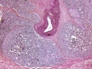 The combination of visual registration and image fusion should be used when targeted biopsy is being performed on men with suspected prostate cancer