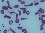 A sickle cell disease prevention and treatment program in the United States has been reauthorized to receive nearly $5 million each year over the next five years.