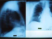 An artificial intelligence system based on deep convolutional neural networks can accurately detect normal chest radiographs
