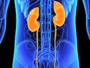 Kidney stones are associated with an increased risk for renal cell carcinoma (RCC)