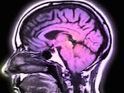 Older adults have an increased risk for dementia after concussion