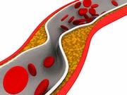 Major bleeding occurs in about 4 percent of lower-extremity peripheral vascular intervention procedures