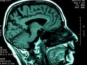 Computer-assisted diagnosis can help physicians detect growth of low-grade gliomas
