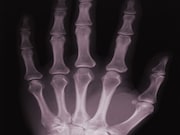 Serum interleukin-35 levels are associated with bone loss and may represent a novel therapeutic target for postmenopausal women with rheumatoid arthritis