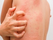 Ligelizumab appears to be a safe and effective treatment option for chronic spontaneous urticaria