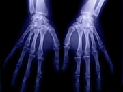 Joint recesses with bone erosion are more likely to exhibit greater severity of joint inflammation on ultrasound examination