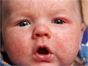 Daily emollient during the first year of life does not prevent eczema in high-risk children