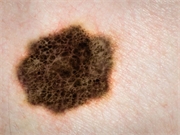 For stage III melanoma patients