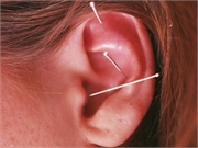 Acupuncture results in an increased response rate and elimination rate for all the cardinal symptoms in patients with postprandial distress syndrome