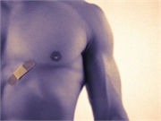 A surgical technique using a modified elliptical excision and nipple-areola complex transposition on a thinned inferior dermal pedicle is an alternative approach for treating male patients with pseudogynecomastia seen after massive weight loss