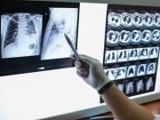 Mortality from non-small cell lung cancer in the United States fell sharply from 2013 to 2016