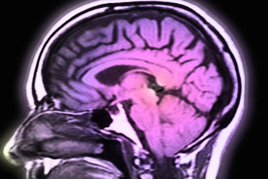 Brain scans may predict which type of therapy will be most effective for obsessive-compulsive disorder in teens and adults