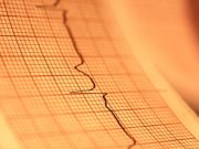 There has been a decline in deaths related to atrial fibrillation over the last 45 years