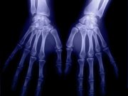 Genetically predicted body mass index significantly increases the risk of rheumatoid arthritis