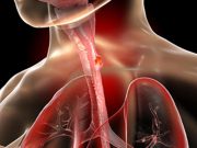 Esophageal Cancer on the Rise in Younger Adults