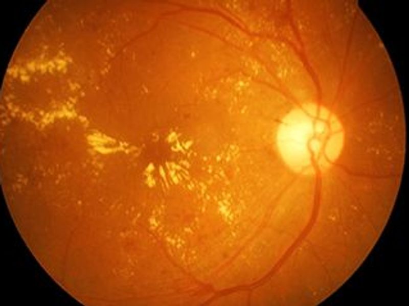 Female Hormone Rx Not Tied to Retinal Vascular Occlusion