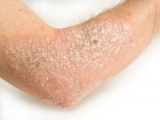 B 1/4 -- Heart Risk Factors May Be Especially Unhealthy in People With Psoriasis