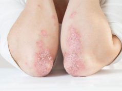 How Safe Is Bimekizumab for Moderate-to-Severe Plaque Psoriasis?