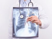 Oncological lung cancer disease concept. Doctor holding medical lung body x-ray photo with pinned white ribbon as a symbol of lung cancer on white isolated background