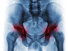 Intra-Articular Injection of Triamcinolone Beneficial in Hip Osteoarthritis