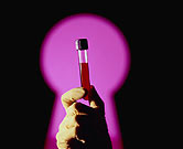 Time-Updated Hemoglobin A1c Variables Linked to MI Risk Time-updated hemoglobin A1c (HbA1c) variables have a stronger association with myocardial infarction than baseline HbA1c