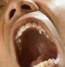 Study IDs Factors Linked to Improved Survival in OCSCC Factors associated with improved survival in oral cavity squamous cell cancer include neck dissection and treatment at academic or research institutions