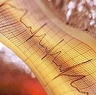 Race and Sex Impact Treatment in Newly Diagnosed A-Fib For patients newly diagnosed with atrial fibrillation