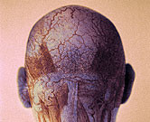 Photodynamic Tx Viable for Paget’s Disease on Scalp Extramammary Paget's disease on the scalp can be successfully treated with photodynamic therapy