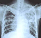Characteristics of Tuberculosis Source Cases Identified In 26 U.S. tuberculosis outbreaks the initial source case-patients had long incubation periods and were characterized by substance abuse